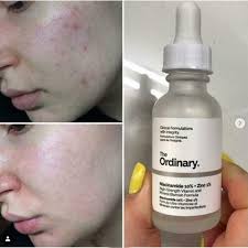 The Ordinary Niacinamide 10% + Zinc 1 % – 30ml Serum